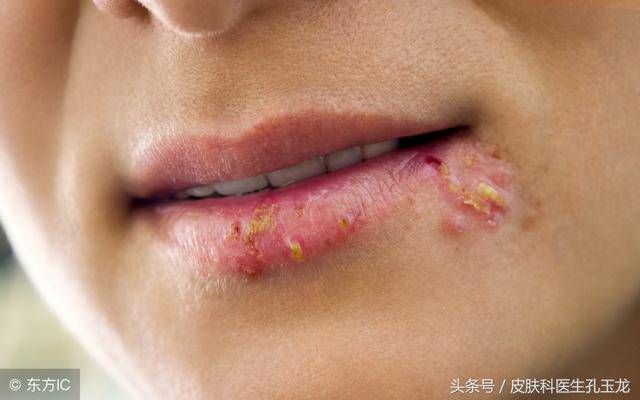 皮肤科常见疾病:嘴唇上火的真相——单纯疱疹
