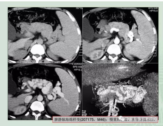 胰腺常見變異ct,mri表現(二)