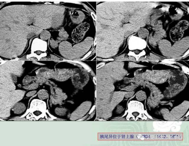 胰腺常见变异ct,mri表现(一)