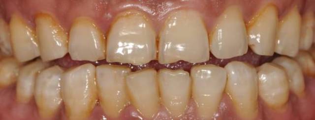 前牙美学修复(贴面 全冠)