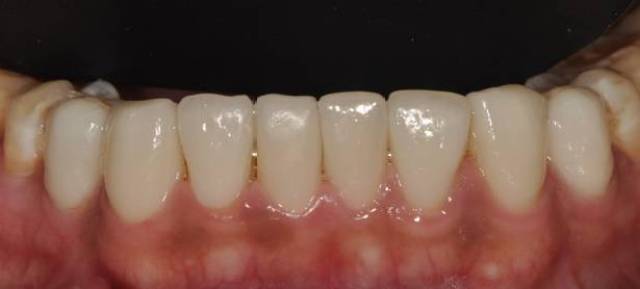 前牙美学修复(贴面 全冠)