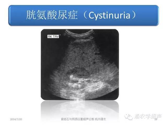 【超声微课堂】肾结石和肾钙质沉着症超声表现的异同之二