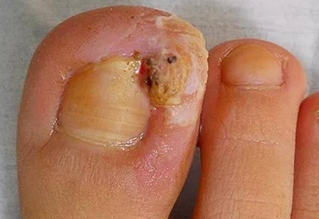 但是患处护理得不好,细菌感染就有可能演变成真菌感染,就会传染