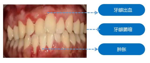 牙龈萎缩不可逆也许德国生物口腔吸收疗法会给你不一样的答案
