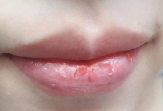 润唇膏过敏(润唇膏过期了有什么妙用)