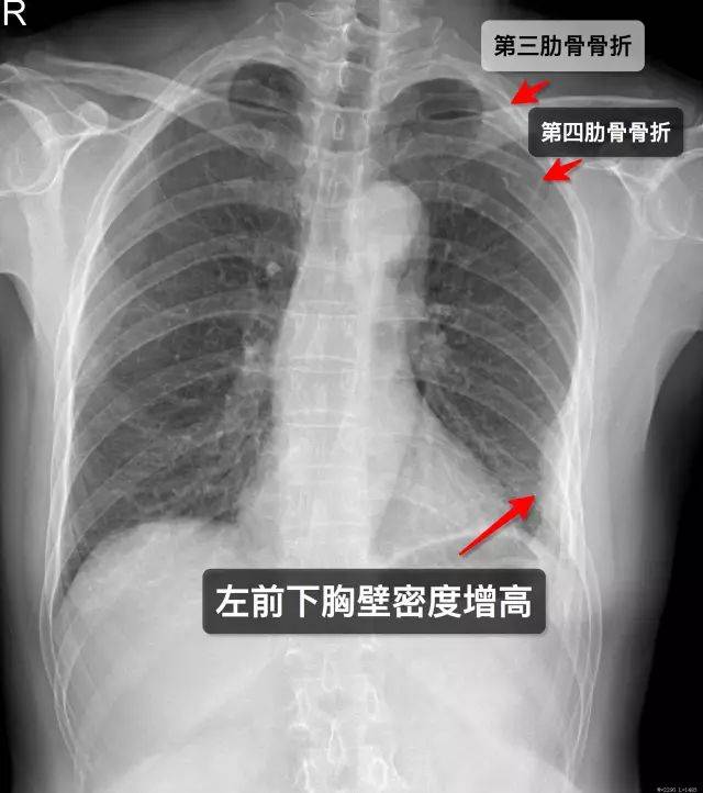 胸骨骨折x光高清图片图片