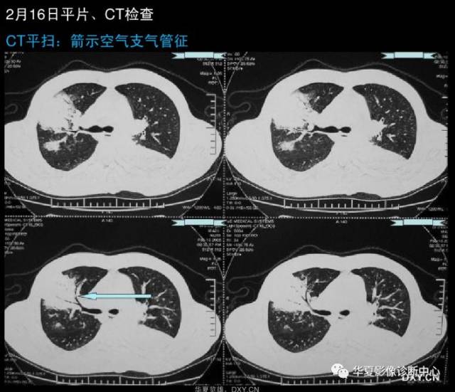 正常肺对比肺癌ct图片图片