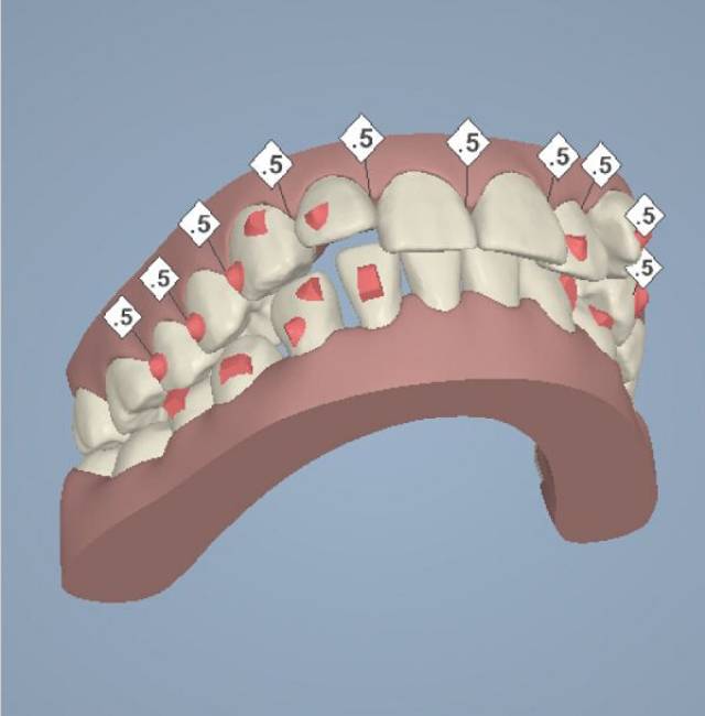 北京隐适美拔牙矫正干货分享,嘴突龅牙的最后