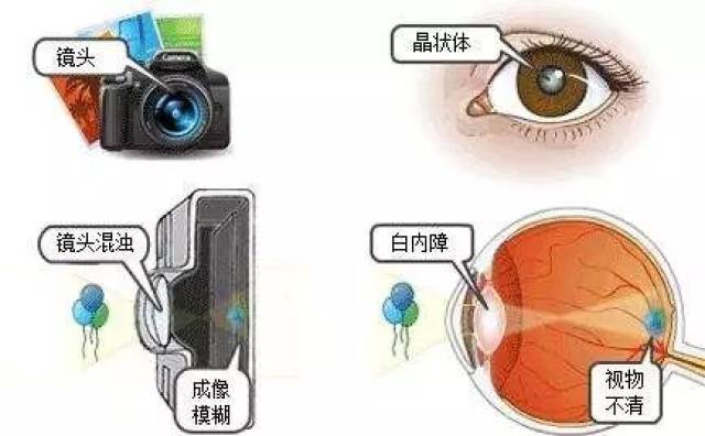 得了糖尿病性白内障该如何治疗