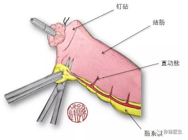 胆肠吻合器吻合术图解图片