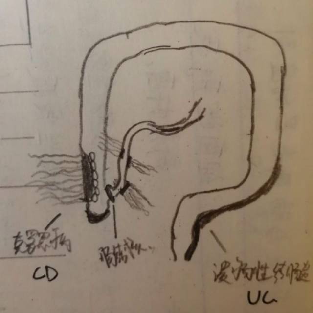 开始逆行向近段发展,一般局限于黏膜与黏膜下层,很少深入肌层(铅管征)