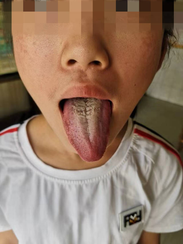 肠胃湿热症导致反复性强的闭口开口粉刺痘,这