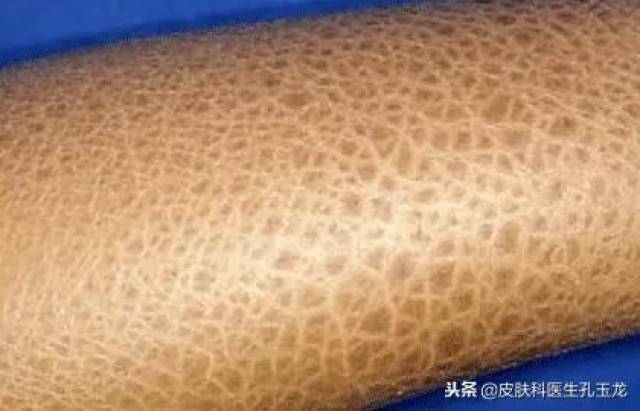 皮肤科常见疾病系列:小腿长的像鱼鳞一样的东西是什么