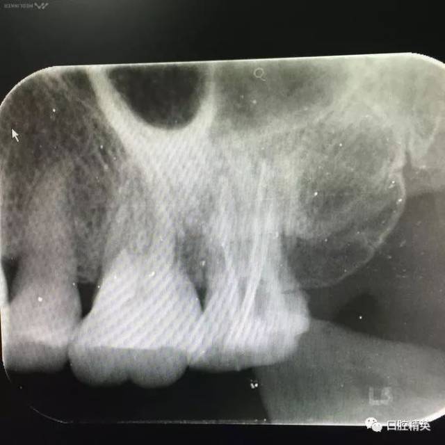 牙髓炎x光片表现图片