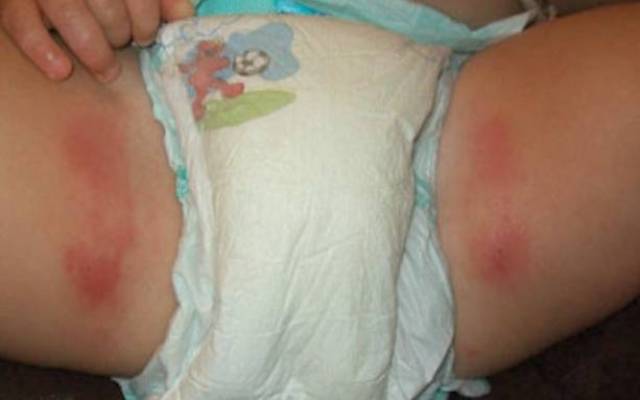 指的都是被尿布覆盖的区域及附近发生的皮疹或过敏