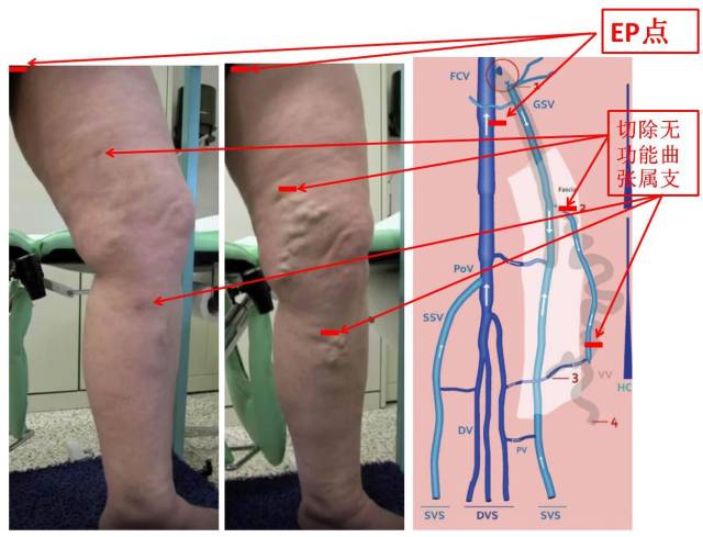 chiva傳奇:下肢靜脈曲張的極致微創手術,保留大隱靜脈