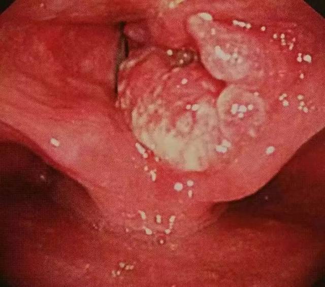 咽喉癌图片和正常图片图片