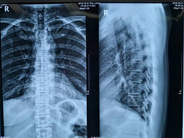 后路胸椎管减压,植骨融合内固定术案例解析