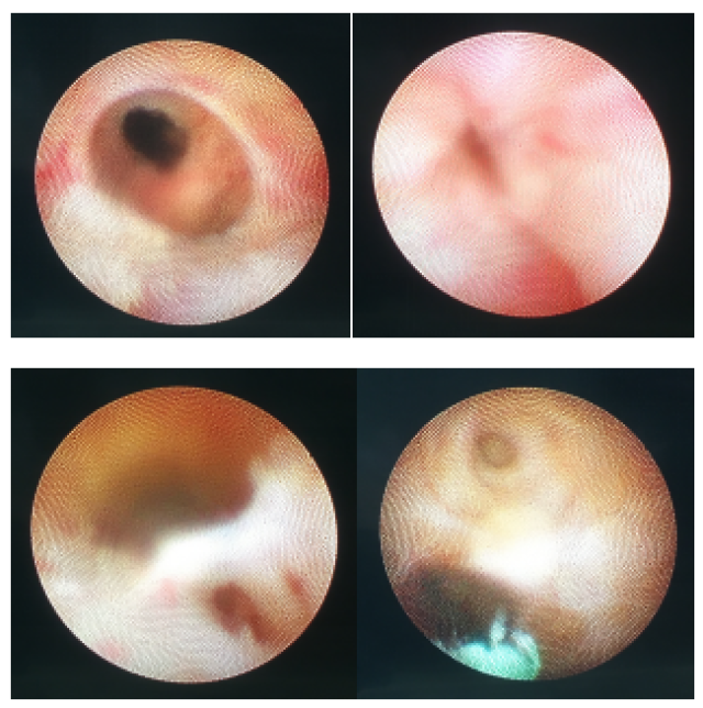 图一: 我科常规开展"精囊镜"治疗