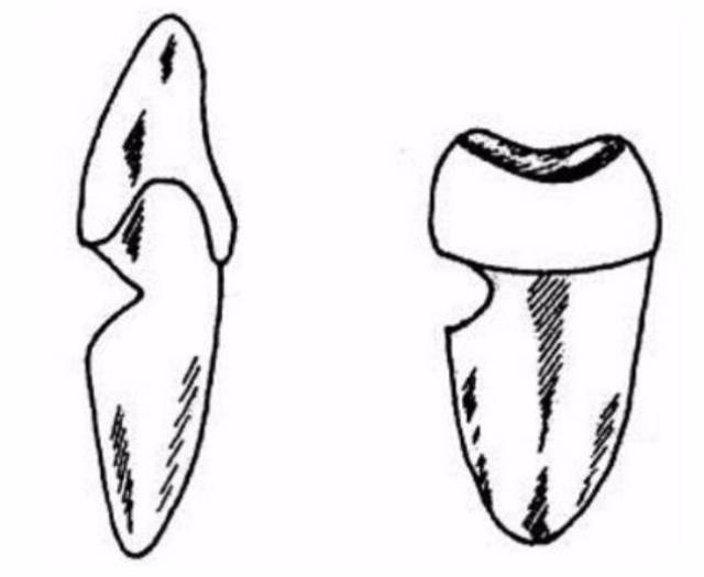 牙齿楔状缺损常常出现在前磨牙,尖牙,缺损区呈楔状,边缘整齐,表面光滑