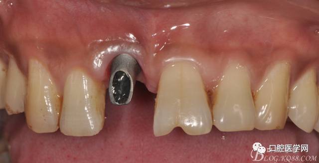 图20 口内修复基台正位照