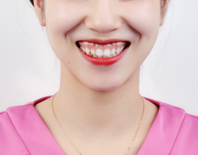 不忍直视的露龈笑 终于鼓起勇气牙齿矫正了!