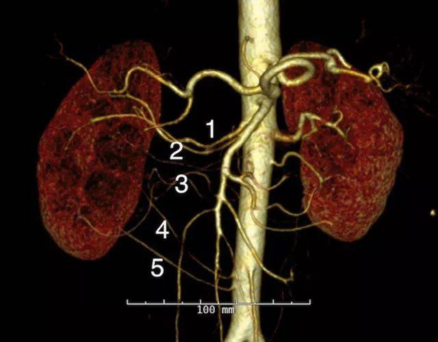 腹部ct显示右肾盂扩张,右肾出现5支肾动脉