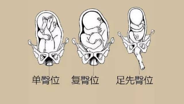 胎儿臀位臀位是异常胎位中最常见的一种,正常的胎儿位置(胎位),应该是