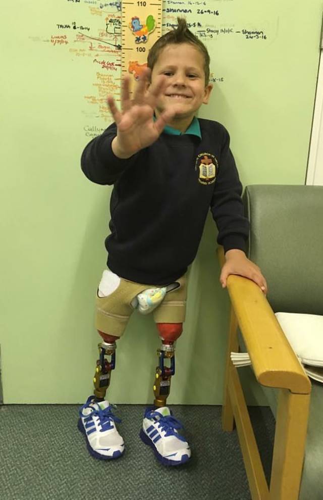 一名因患有罕见爆发性紫癜而膝部以下截肢的7岁英国男孩,日前在没有
