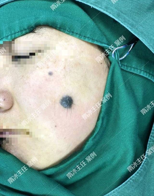 隋冰:切痣手术是如何操作的?