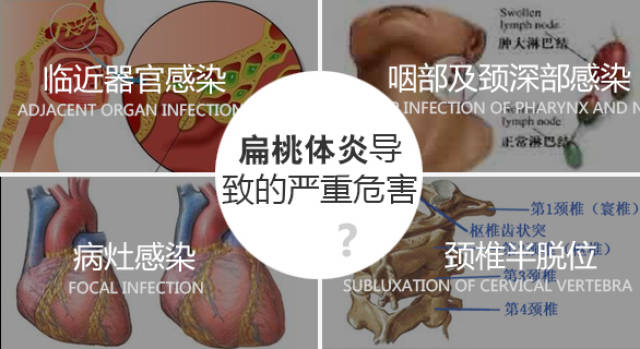 會加重胃熱,熱毒上攻,導致急性扁桃體炎的症狀加重