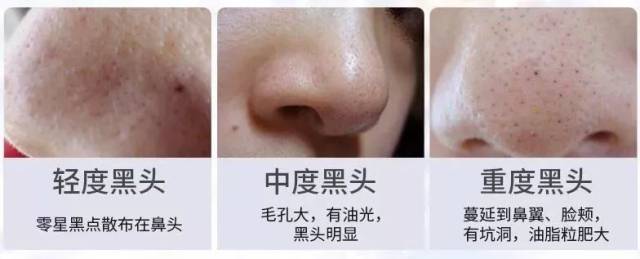 三步解决陈年黑头粉刺!毛孔瞬间隐形,还你细腻少女肌,肌肤年轻十岁