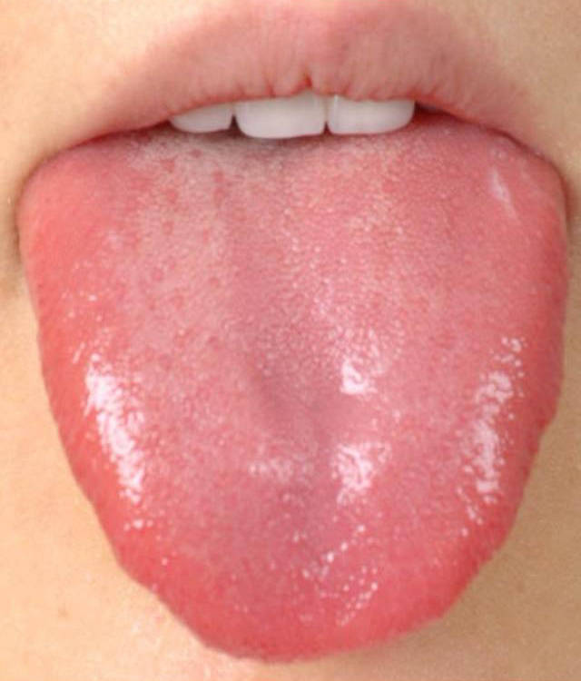 这样的舌头多数舌色较红,舌质嫩,舌面光滑缺少津液,也没有舌苔或者少