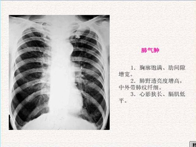 肺气肿可以买重疾险吗 肺气肿买保险