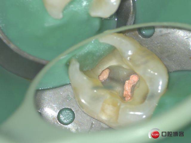 差点遗漏的第四个根管