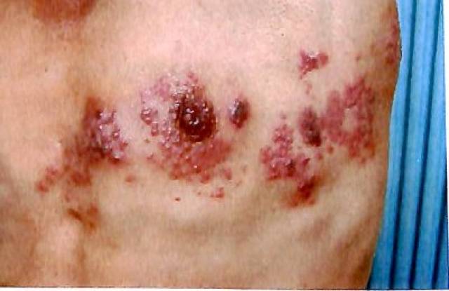 以发热及皮肤和黏膜成批出现周身性红色斑丘疹,疱疹,痂疹为特征.