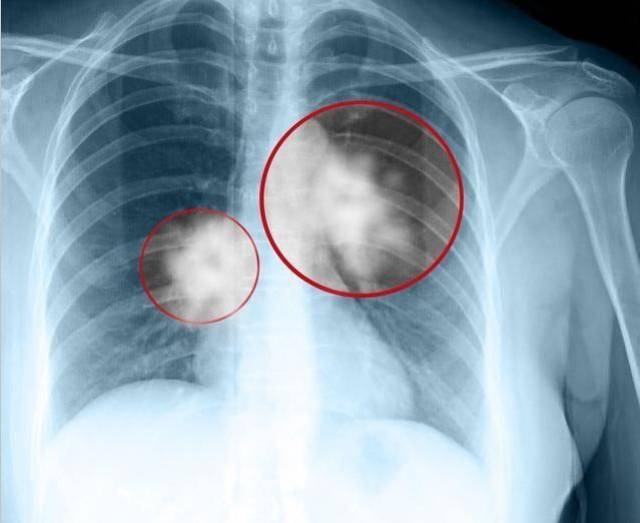肺癌发生悄无声息,一旦四肢有4种标记,当心肺癌已在路上!
