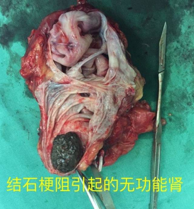 精準解剖--後腹腔鏡下無功能腎切除術