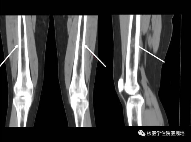 股骨中下段ct 诊断依据: 患者为乳腺原位癌,近期乳腺相关肿瘤标志物
