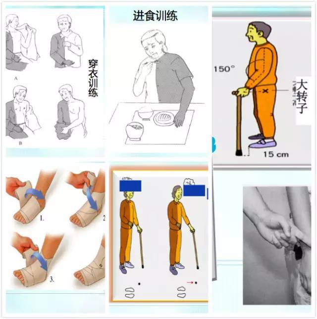 脑卒中的康复训练及治疗大合集!多图详解_手机搜狐网