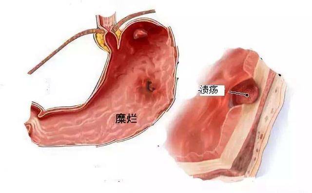 一文弄懂,胃糜烂与胃溃疡!