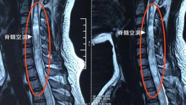 颈段的脊髓空洞,为什么要做腰椎核磁共振?