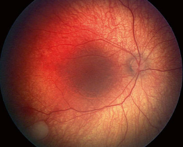 视网膜母细胞瘤 晚期图片