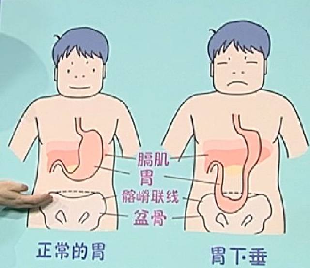 胃下垂的体型图片图片