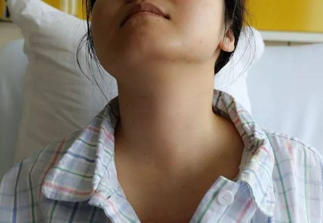 甲状腺手术≠脖子上必留疤!一样可以露出美美哒脖子
