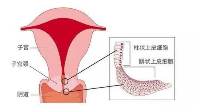 而近现代认为:子宫糜烂是指位于宫颈外口的原始柱状上皮或早