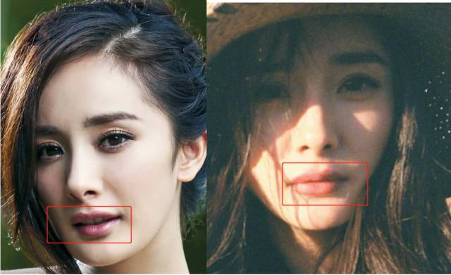 唇珠变得明显,下唇中间的凹缝被填平.