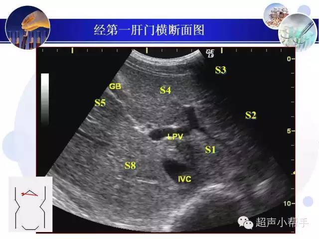 工字部超声图片