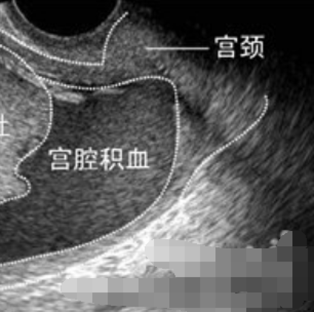 宫腔积血图片图片