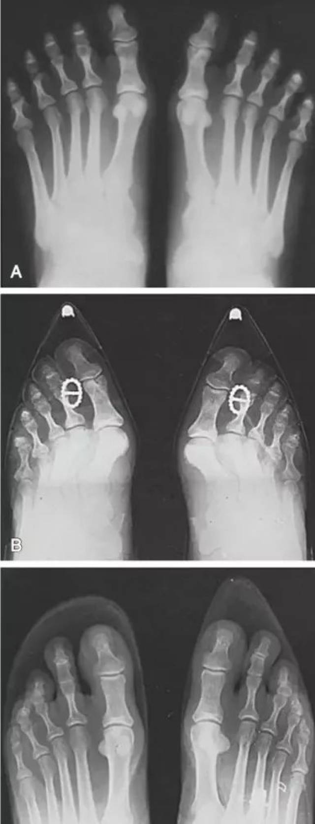大脚趾x光图片